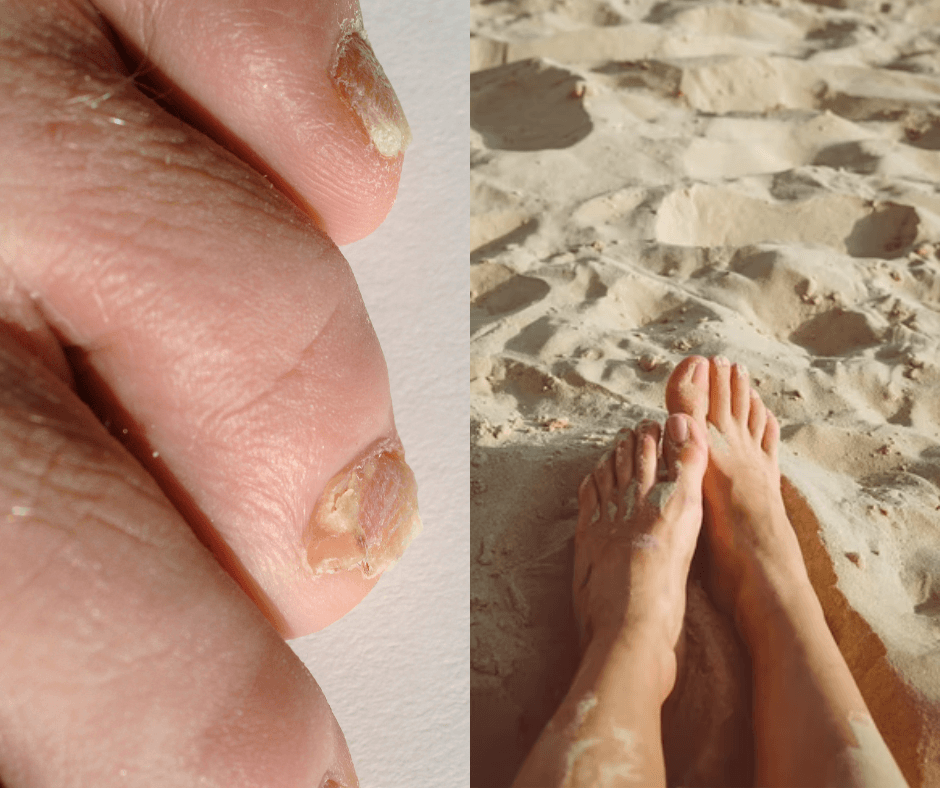 Kako se riješiti gljivica na noktima - savjeti liječnice za prevenciju i liječenje