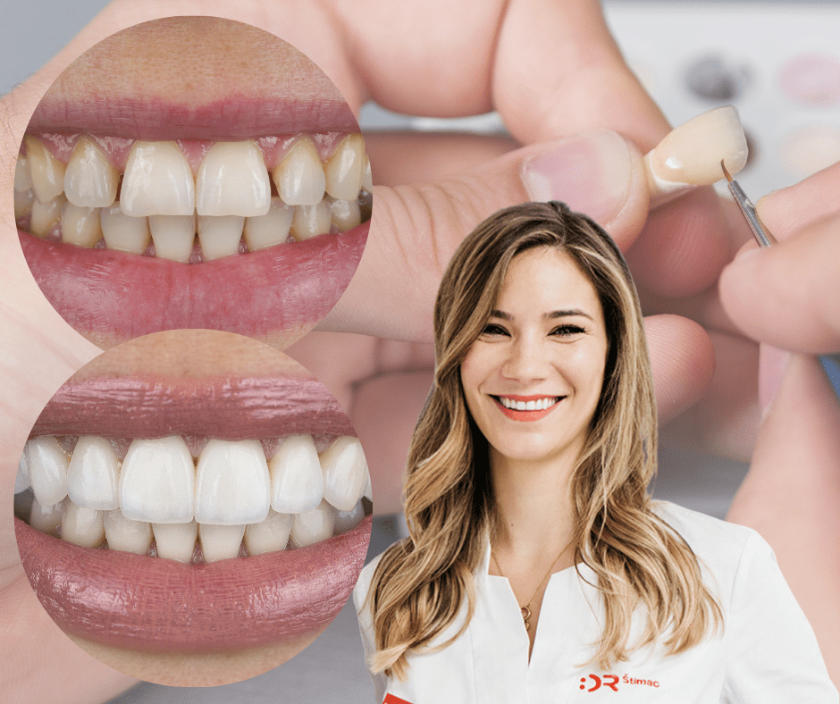 Što sve morate znati ako planirate staviti ljuskice? Specijalistica dentalne protetike otkriva nam tko je idealan kandidat