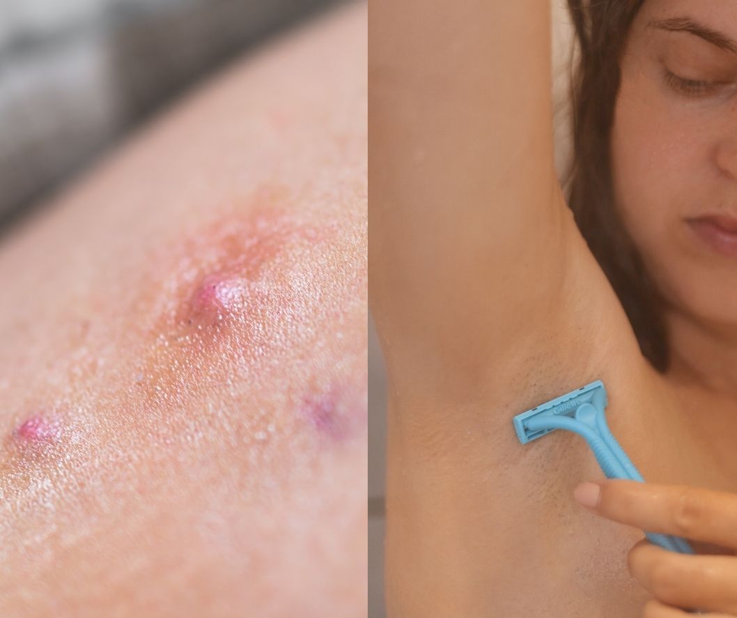 Urasle dlačice prerasle su u neizlječivu bolest, a podršku sam pronašla na neočekivanom mjestu