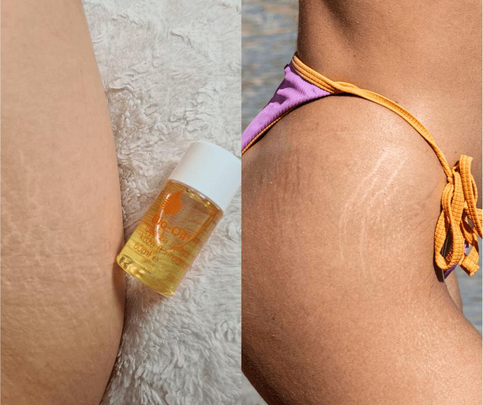 Recenzija različitih ulja za strije – koje je bilo naj(ne)učinkovitije?