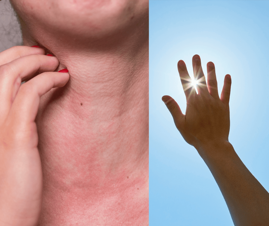 Alergija na sunce: prevencija, liječenje i savjeti za sigurno izlaganje suncu