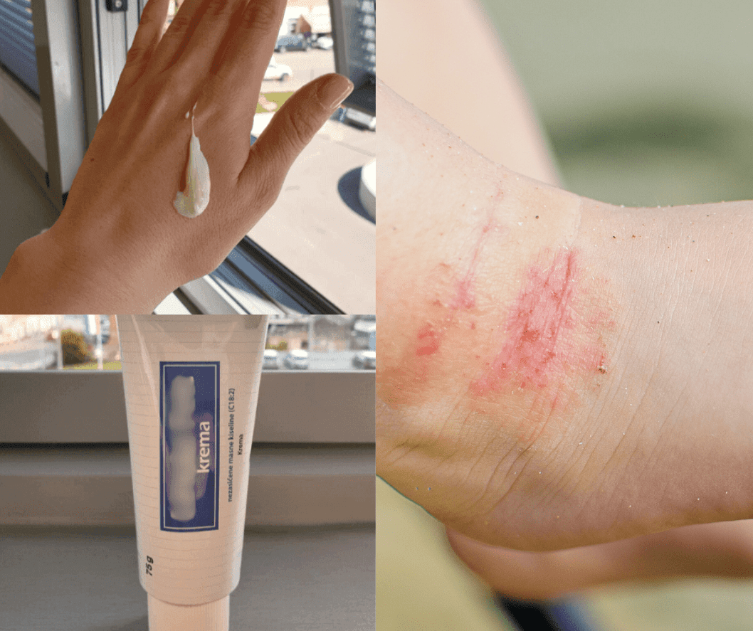 Liječnica iznimno hvali ovu kremu za liječenje atopijskog dermatitisa: pogledajte rezultate na koži beba