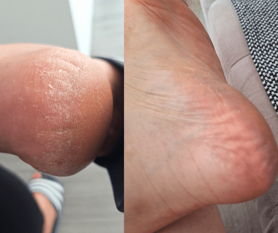 Ljeti zaobilazim običnu pedikuru i uvijek se odlučujem za medicinsku: evo zašto biste trebali i vi