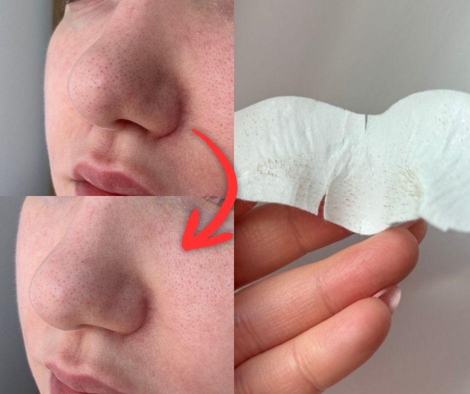 Jedine trakice za uklanjanje mitesera koje doista djeluju: koštaju oko 5 eura