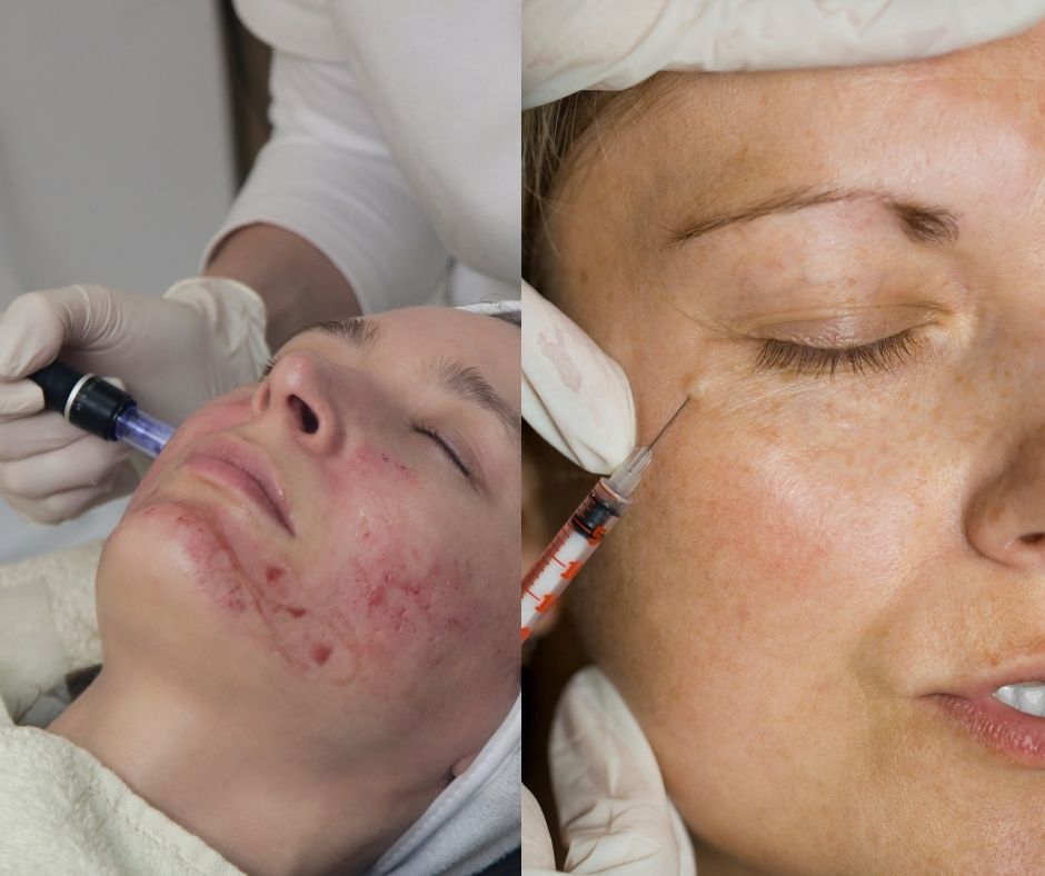 Estetski tretmani – farmaceutkinja izdvaja važne informacije o botoksu, hijaluronu i mezoterapiji