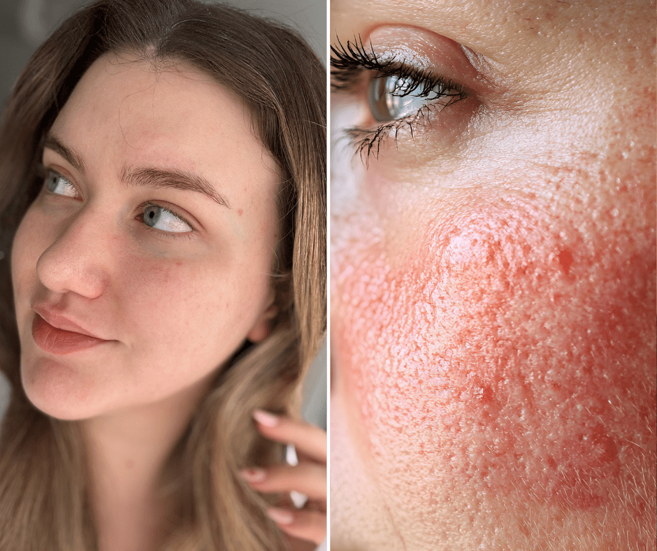 Kako sam prestala s "overcleansingom" i spasila svoju dehidriranu kožu lica?