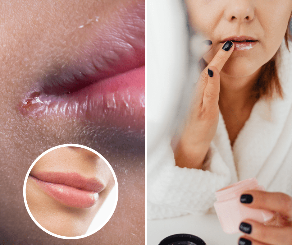 Koji su uzroci nastanka pukotina na rubovima usana i što doista pomaže?