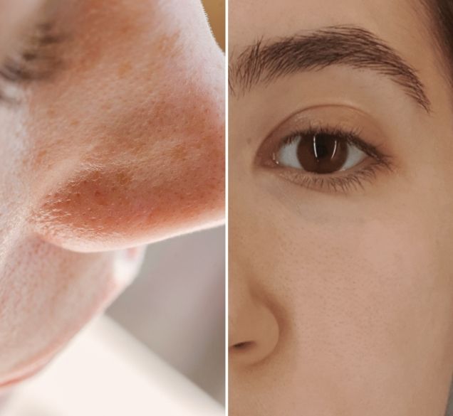 Proširene pore mogu se umanjiti – kako moje lice sada izgleda i koje sam proizvode upotrebljavala?