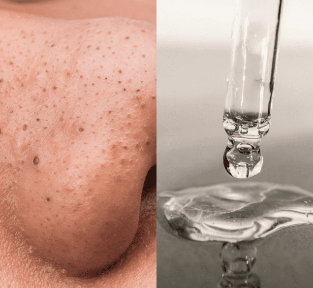 Osobna preporuka: 5 najboljih kozmetičkih proizvoda za uklanjanje mitesera