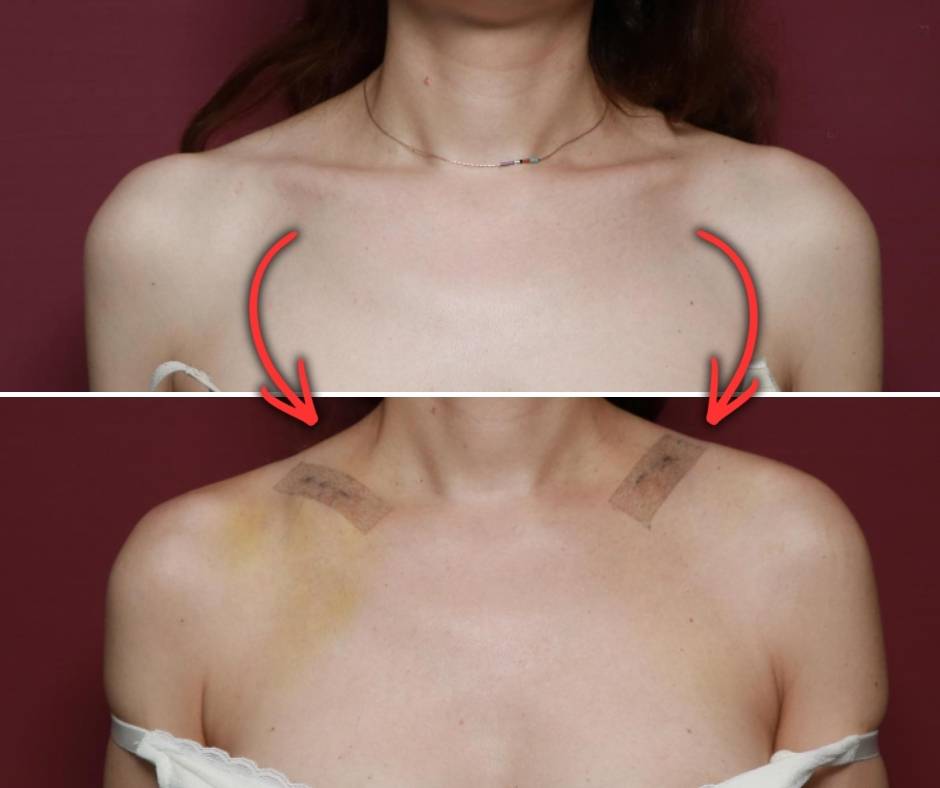 Novi besmisleni trend vlada svijetom i pitamo se ima li kraja: zahvatom se uklanja dio ključne kosti