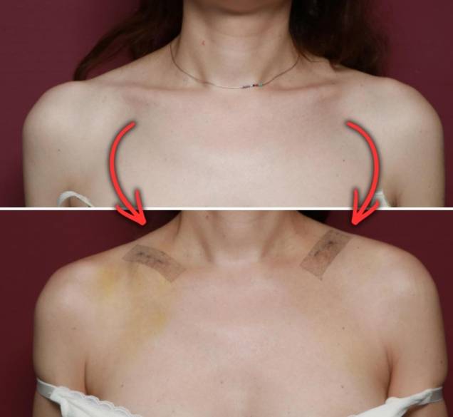 Novi besmisleni trend vlada svijetom i pitamo se ima li kraja: zahvatom se uklanja dio ključne kosti