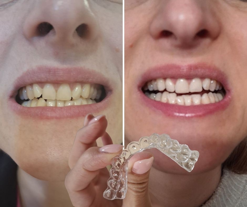 Isprobala sam kućno izbjeljivanje zubi s udlagama – isplati li se dati 280 eura?