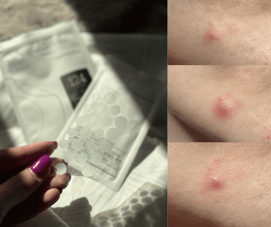 Flasteri protiv prištića pomogli su mi kod jednog problema, ali kod drugog nisu napravili gotovo ništa